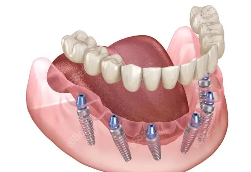 半口种植牙 半口种植牙