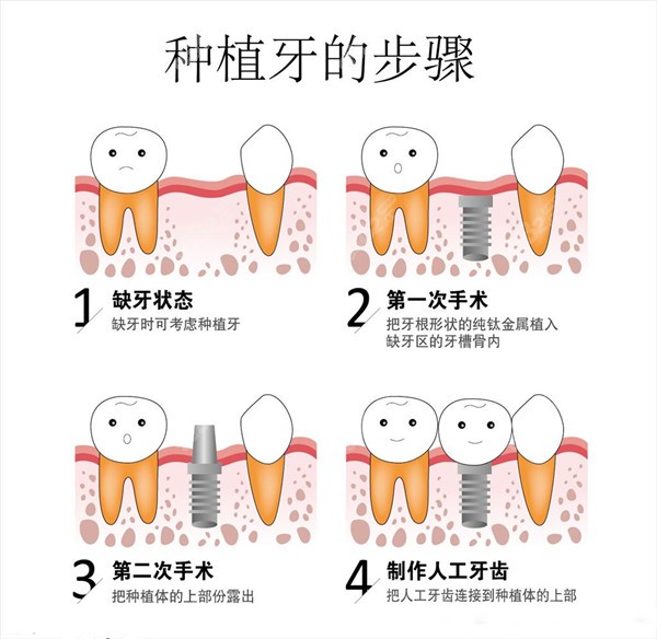 种植牙流程 种植牙流程