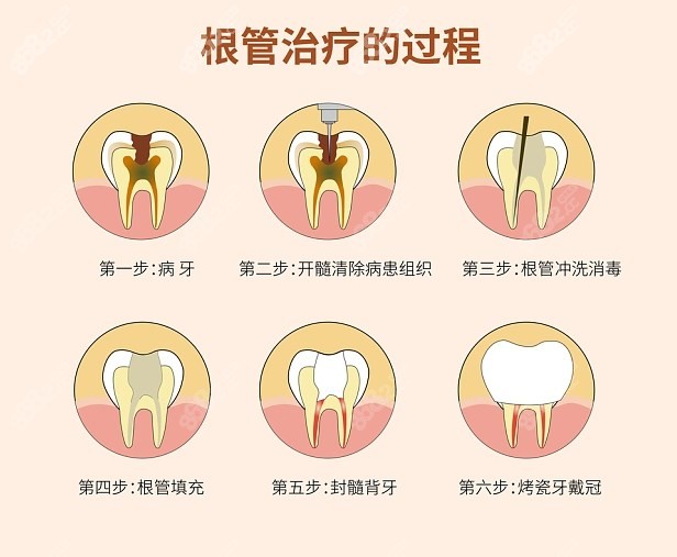 牙科根管治疗流程