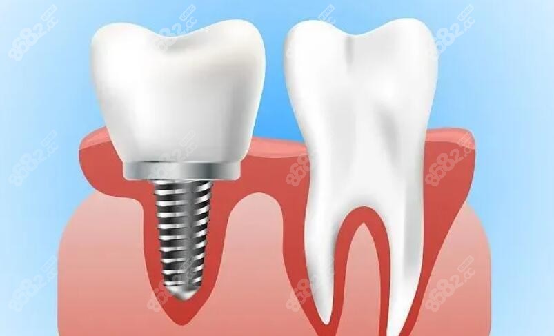 单颗种植牙的优势www.8682.cc
