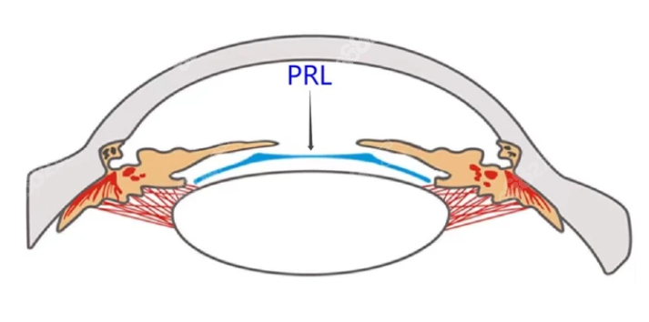 prl人工晶体