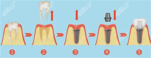 种植牙过程图