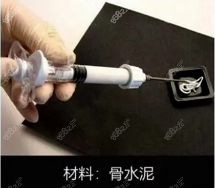 后脑勺骨水泥填充结果不错一般没骨水泥腐蚀骨头的危害或缺点