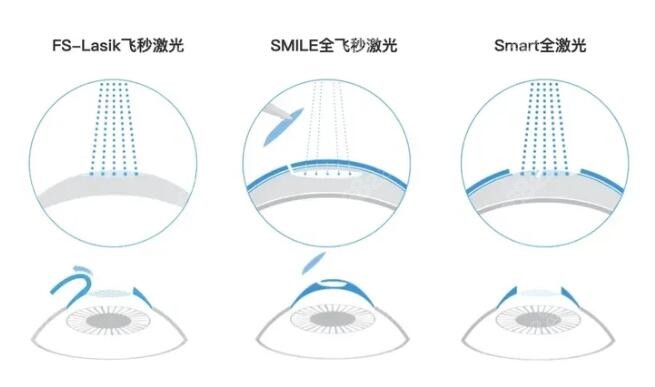 半飞秒手术多少钱