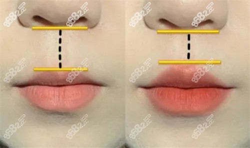 人中縮短手術(shù)價格