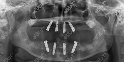 全口种植术后ct照片