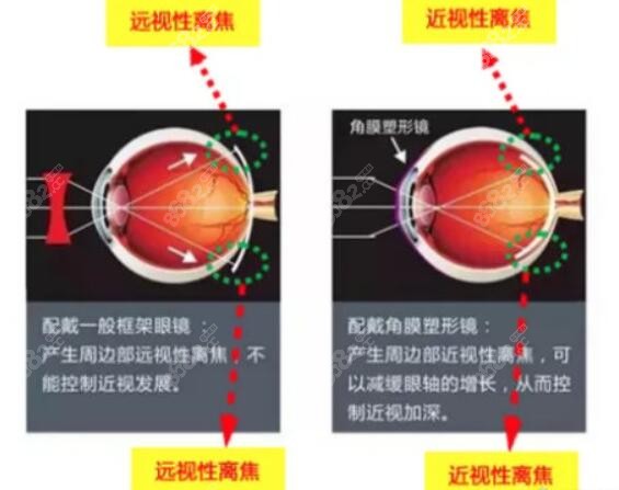 深圳配角膜塑形镜要多长时间m.8682.cc