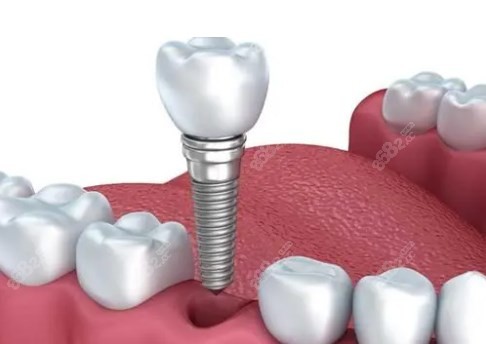 齐齐哈尔种植牙