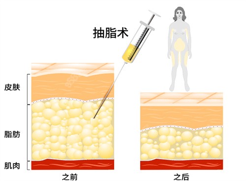 抽脂术前后对比图