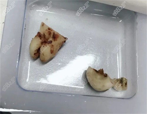拔掉的牙齒照片