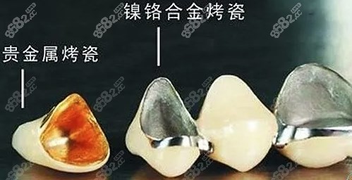 烤瓷牙