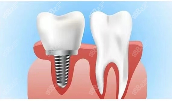 单颗种植牙