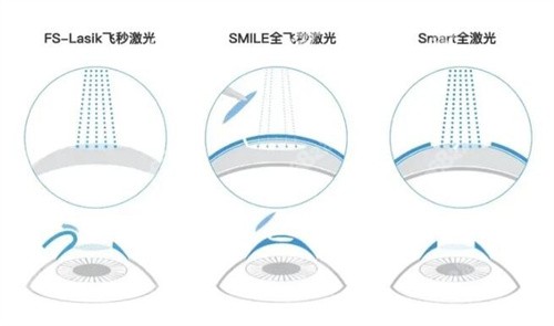 爱尔眼科近视手术费用可以报销吗？