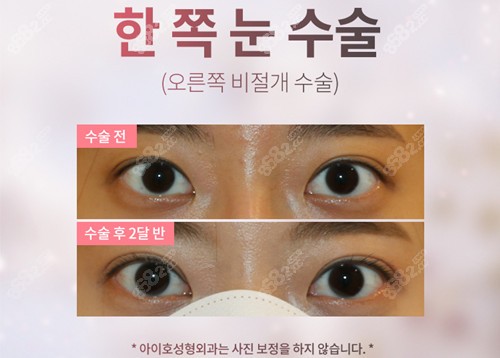 韩国爱护医院眼修复实例