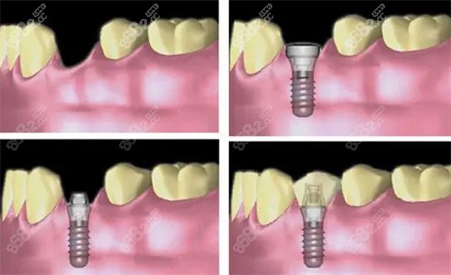 种植牙手术流程图