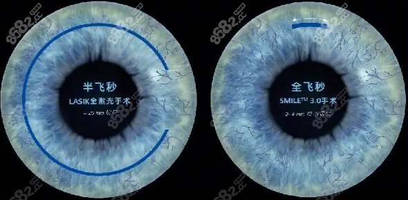 青岛全飞秒手术价格21000元起