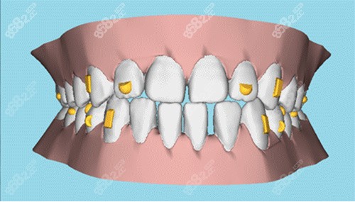 牙齿矫正图