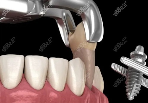 拔牙動(dòng)畫圖