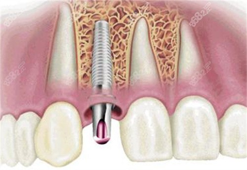 种植体植入过程图