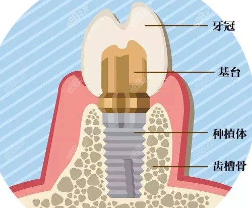 种植牙结构示意图