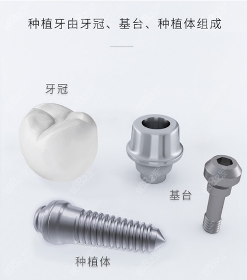种植牙组成部分展示