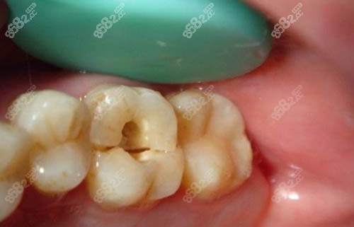 牙齒齲壞補(bǔ)牙照片