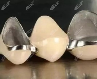 金属耐腐蚀