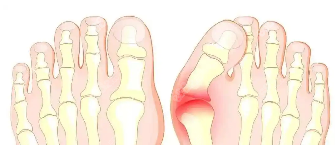 大腳骨手術(shù)前后對(duì)比圖