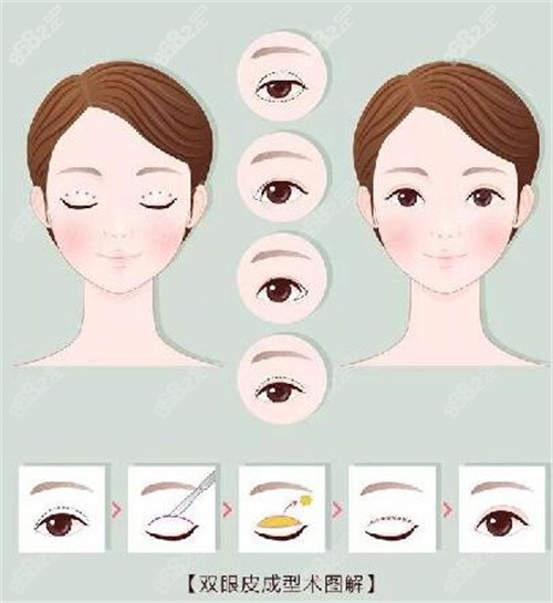 双眼皮手术过程