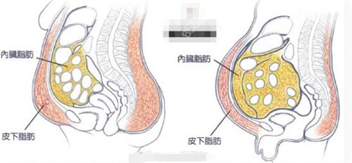 深圳美加美吸脂示意图