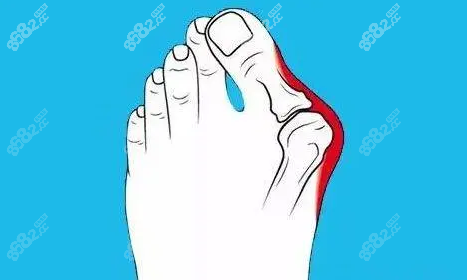 大腳骨手術(shù)親身經(jīng)歷