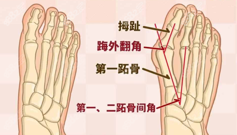 拇指外翻能調(diào)整回來(lái)