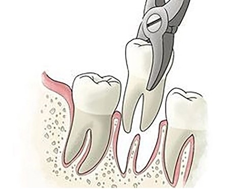 医院牙科拔牙