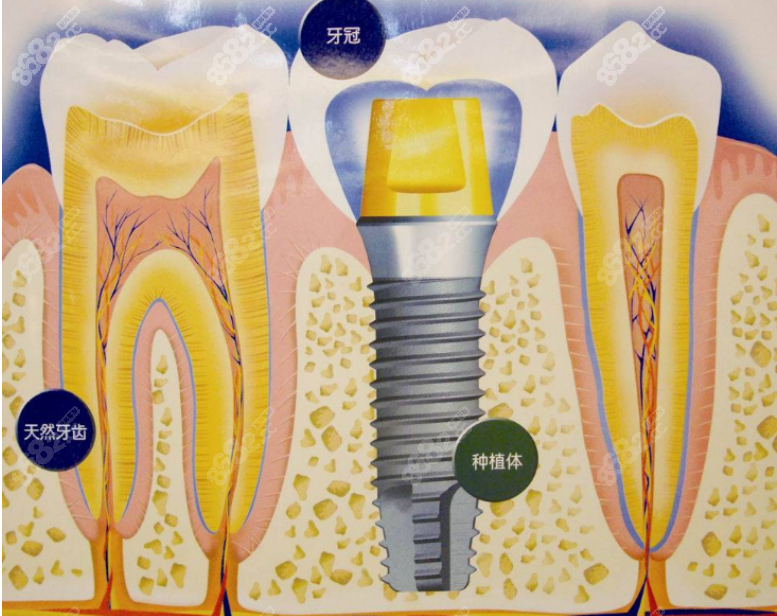 上海鼎植口腔种植牙