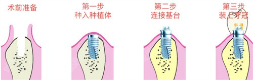 种植牙手术流程图