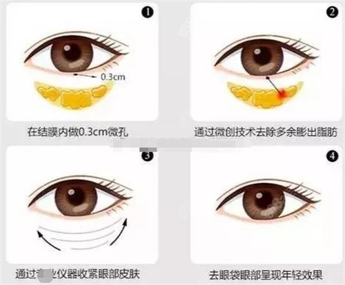 深圳美加美去眼袋
