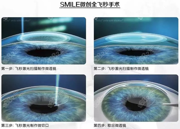 全飞秒手术过程示意图