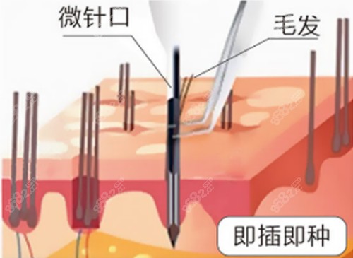 广州大海植发技术介绍