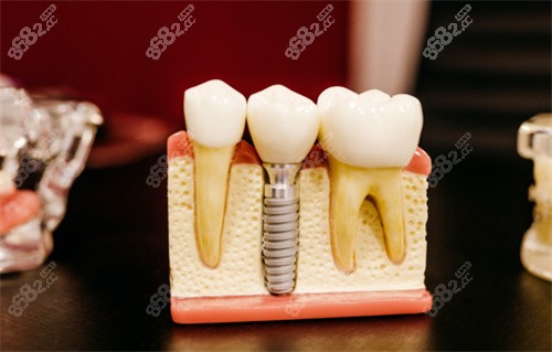 種植牙模型展示圖