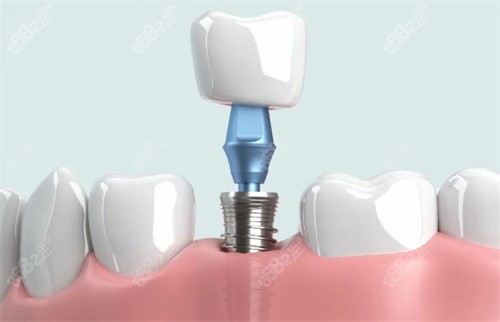 單顆種植牙植入動(dòng)畫圖