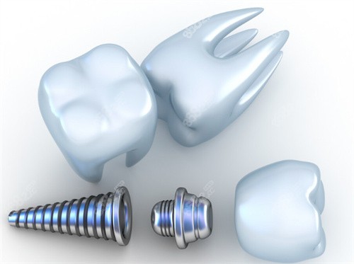 种植牙图片 种植牙图片