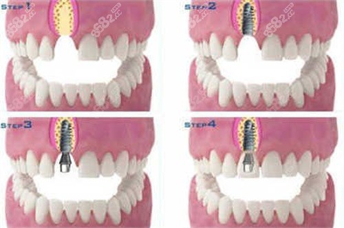 立得用种植牙 立得用种植牙
