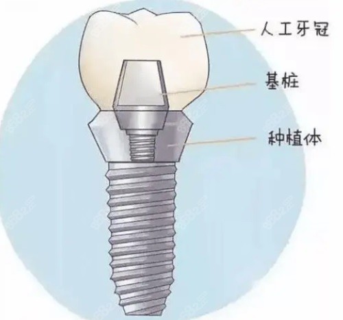 种植牙组成示意图 种植牙组成示意图