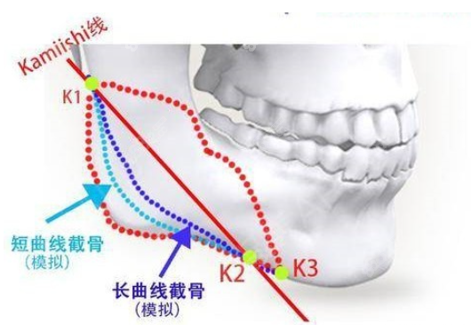 长曲线下颌角截骨