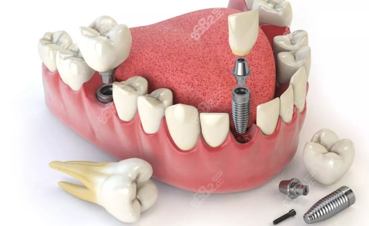 美國種植牙質(zhì)量 美國種植牙質(zhì)量