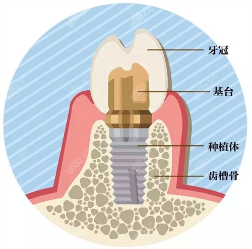 种植牙示意图 种植牙示意图