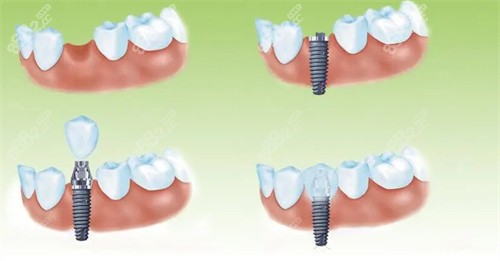種植牙流程展示圖