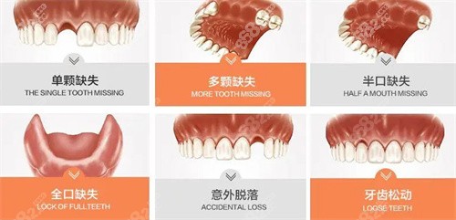 口腔牙齿确实情况展示图