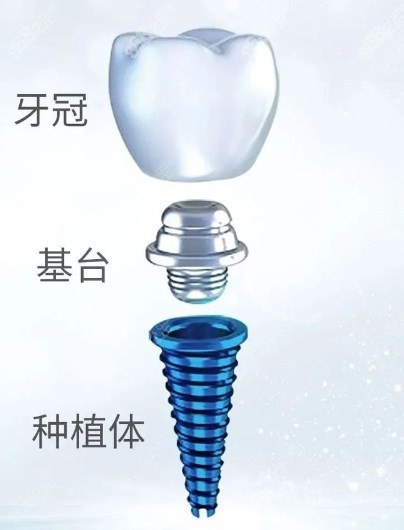种植牙牙冠脱落