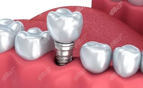 种植牙示意图 种植牙示意图
